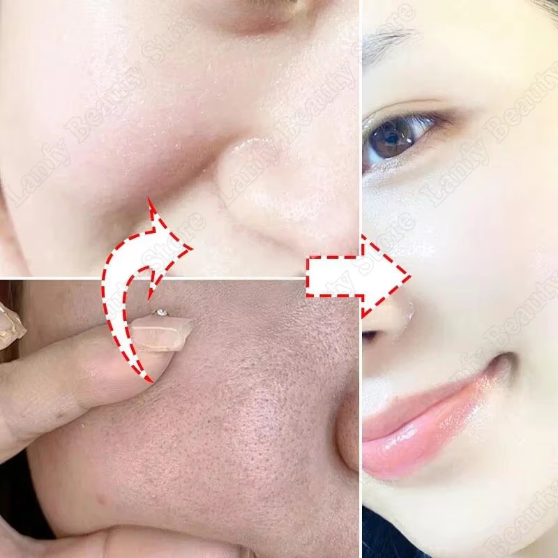 كريم حمض الساليسيليك لتنظيف ال - مراجعة Salicylic Acid Blackhead Remover وسعره