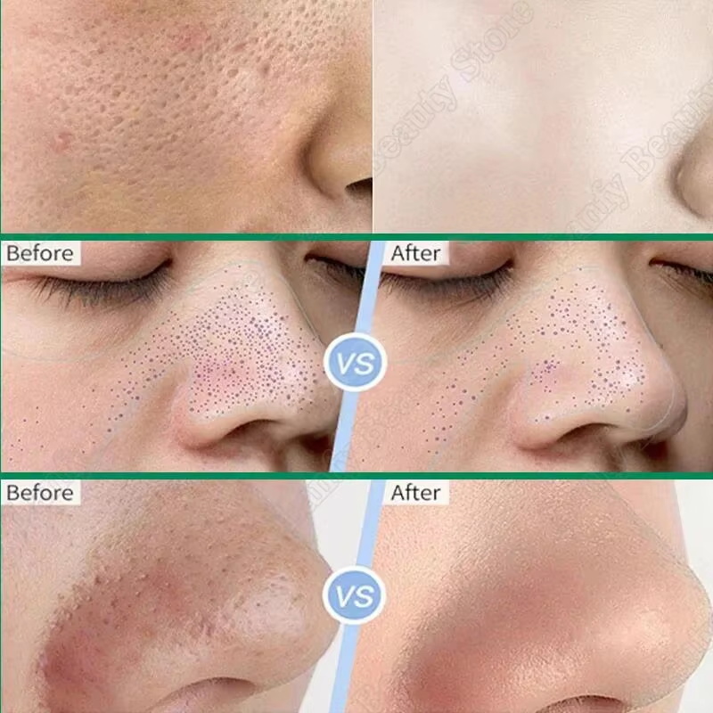 كريم حمض الساليسيليك لتنظيف ال - مراجعة Salicylic Acid Blackhead Remover وسعره